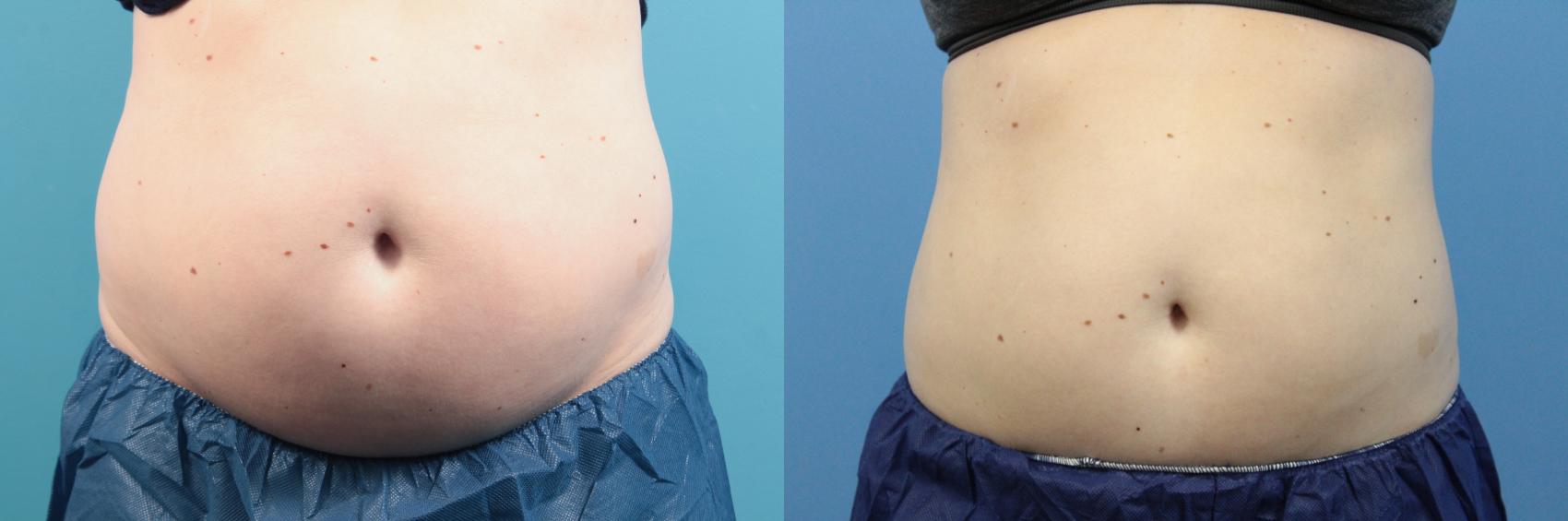 Before & After CoolSculpting® Case 117 Front View in West Des Moines, IA