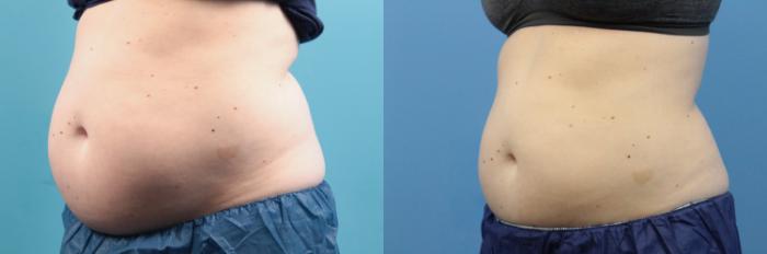 Before & After CoolSculpting® Case 117 View #2 View in West Des Moines, IA