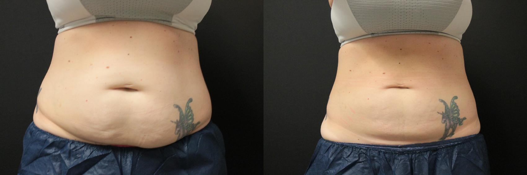 Before & After CoolSculpting® Case 231 Front View in West Des Moines, IA