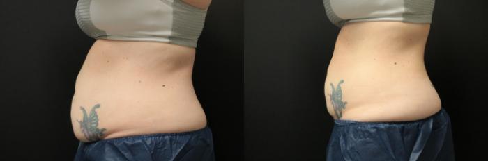Before & After CoolSculpting® Case 231 Left Side View in West Des Moines, IA