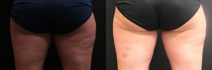 Before & After CoolSculpting® Case 251 Back View in West Des Moines & Ames, IA