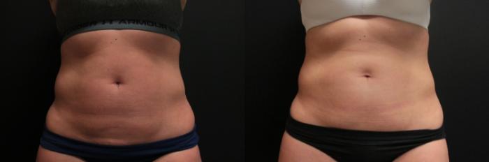 Before & After CoolSculpting® Case 251 Front Abdomen View in West Des Moines & Ames, IA
