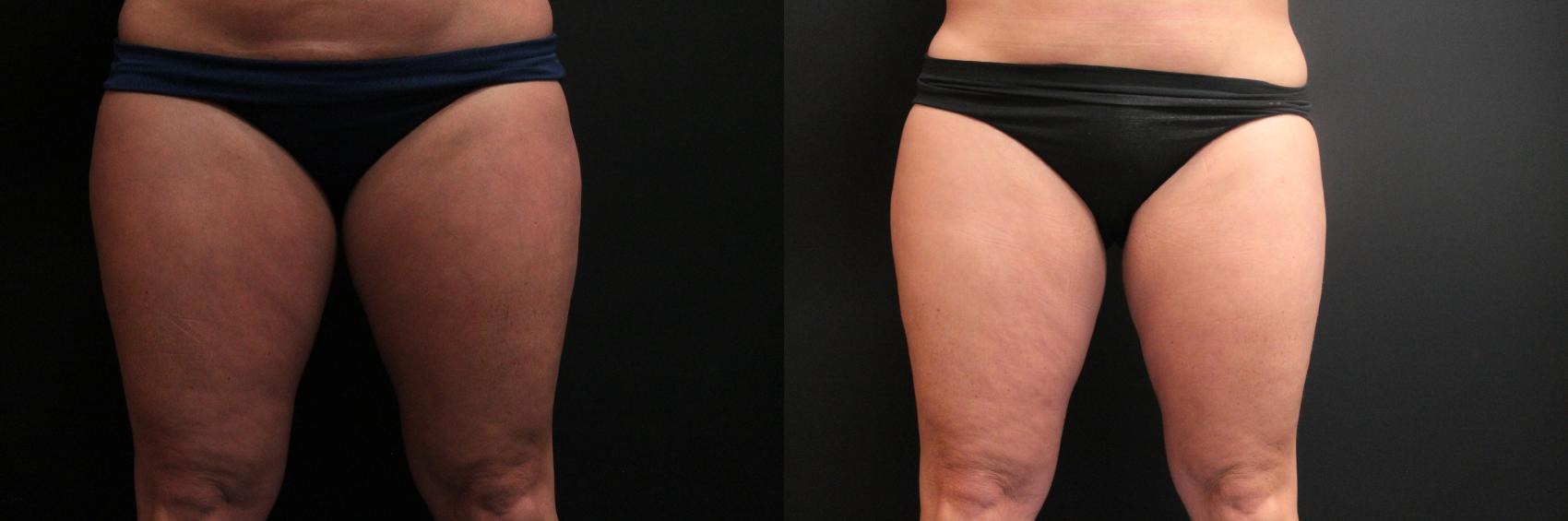 Before & After CoolSculpting® Case 251 Front View in West Des Moines & Ames, IA