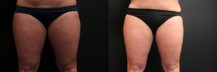 Before & After CoolSculpting® Case 251 Front View in West Des Moines, IA