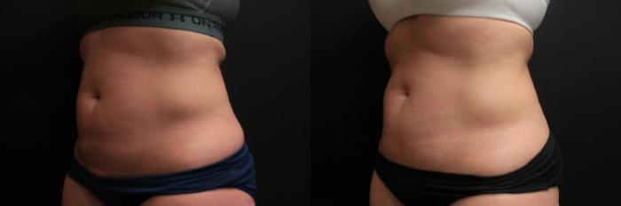 Before & After CoolSculpting® Case 251 Left Oblique View in West Des Moines & Ames, IA