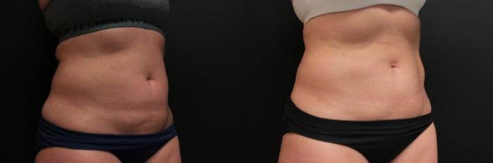 Before & After CoolSculpting® Case 251 Right Oblique View in West Des Moines & Ames, IA