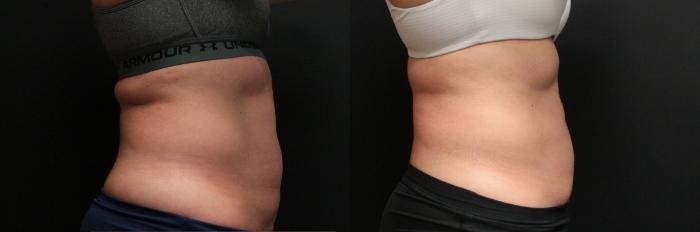 Before & After CoolSculpting® Case 251 Right Side View in West Des Moines & Ames, IA