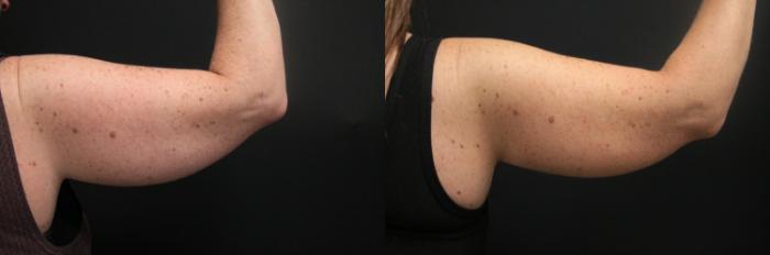 Before & After CoolSculpting® Case 304 Back View in West Des Moines & Ames, IA