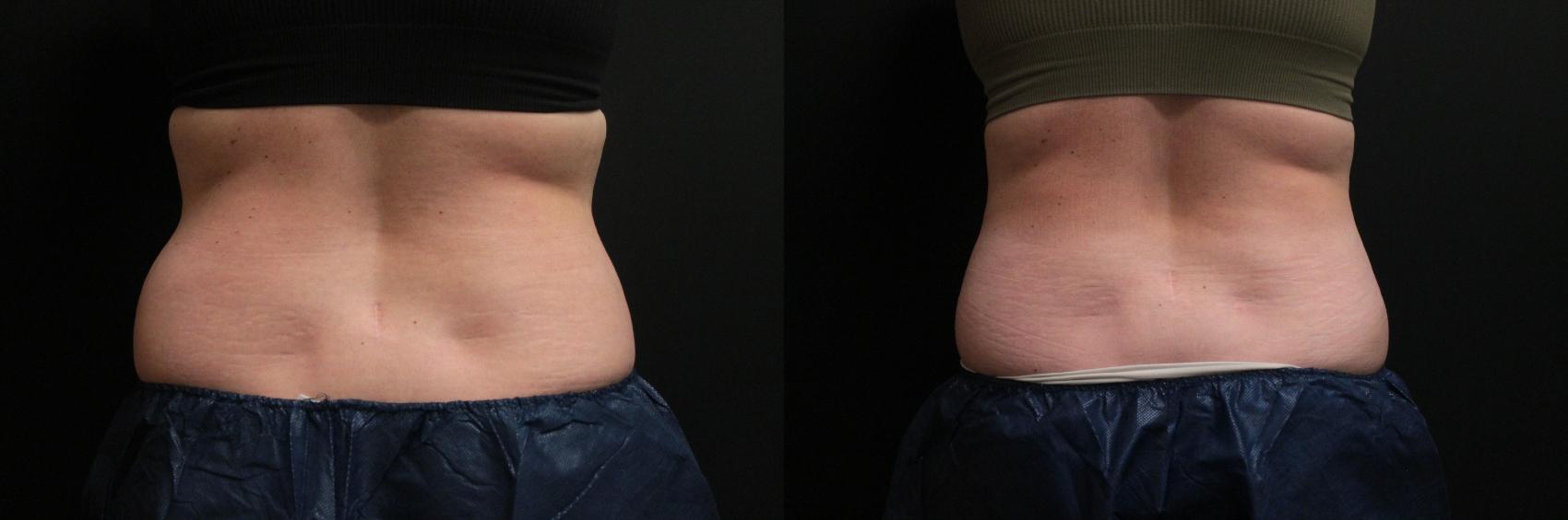 Before & After CoolSculpting® Case 305 Back View in West Des Moines & Ames, IA