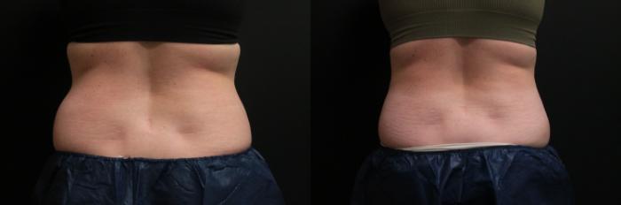 Before & After CoolSculpting® Case 305 Back View in West Des Moines & Ames, IA