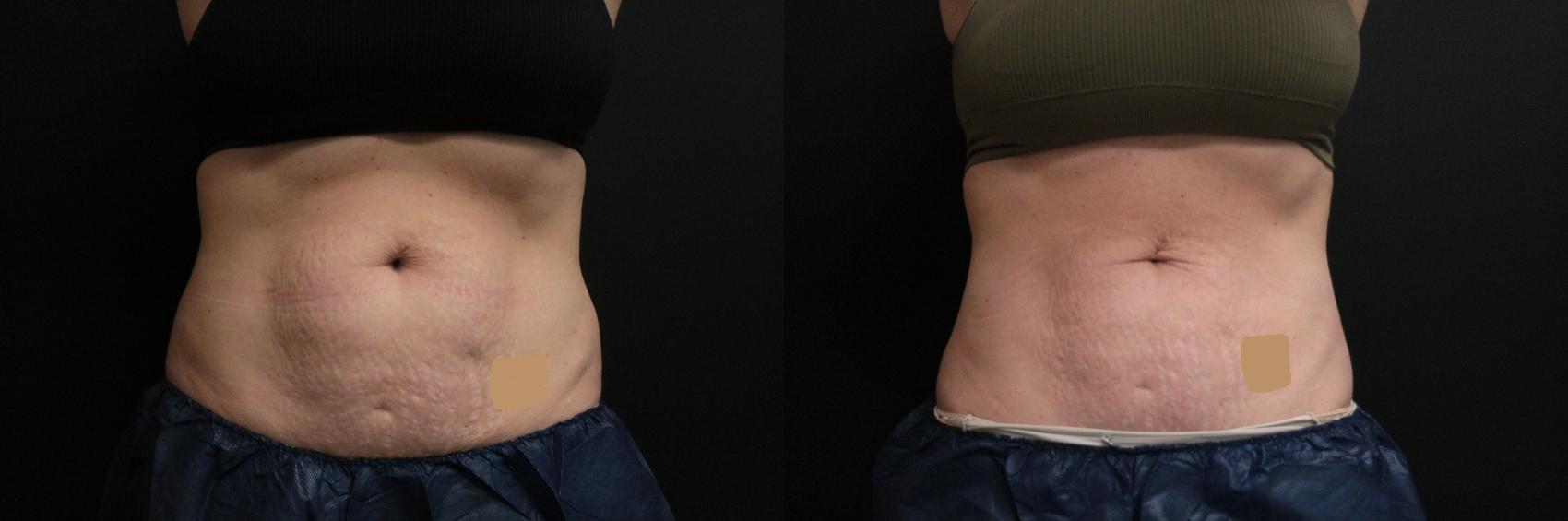 Before & After CoolSculpting® Case 305 Front View in West Des Moines & Ames, IA