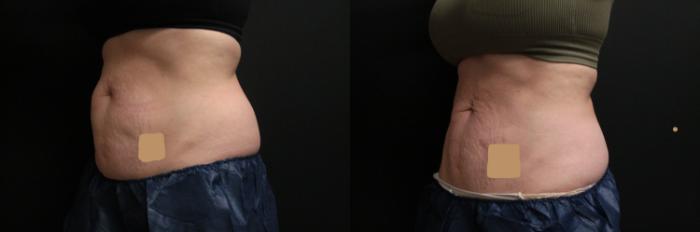 Before & After CoolSculpting® Case 305 Left Oblique View in West Des Moines & Ames, IA