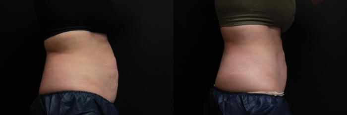 Before & After CoolSculpting® Case 305 Right Side View in West Des Moines & Ames, IA