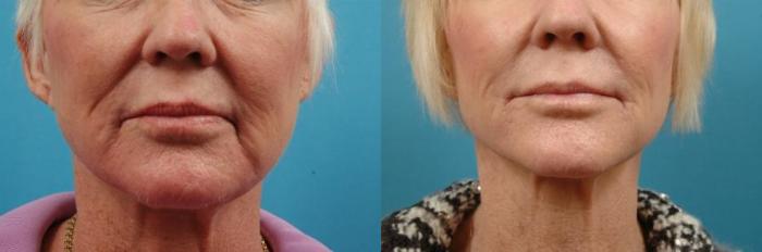 Before & After Dermal Fillers Case 12 View #1 View in West Des Moines, IA