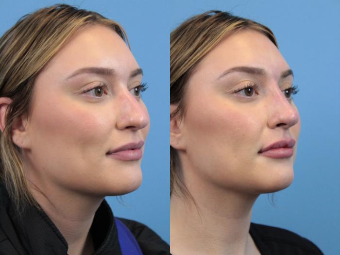 Before & After Dermal Fillers Case 177 View #2 View in West Des Moines & Ames, IA
