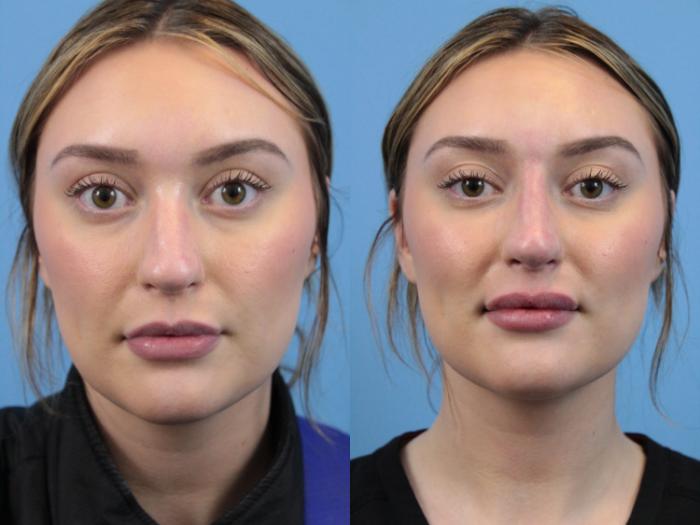 Before & After Dermal Fillers Case 177 View #3 View in West Des Moines & Ames, IA