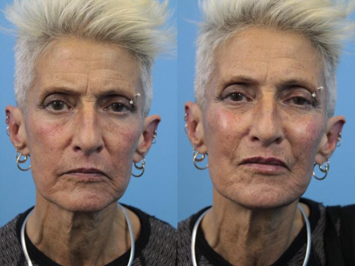 Before & After Dermal Fillers Case 203 Front View in West Des Moines, IA