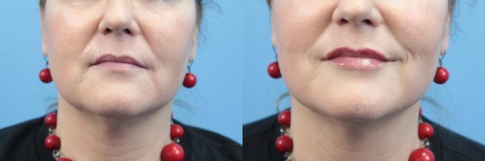 Before & After Dermal Fillers Case 394 Front lips View in West Des Moines & Ames, IA
