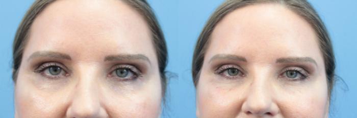 Before & After Dermal Fillers Case 394 Front View in West Des Moines & Ames, IA