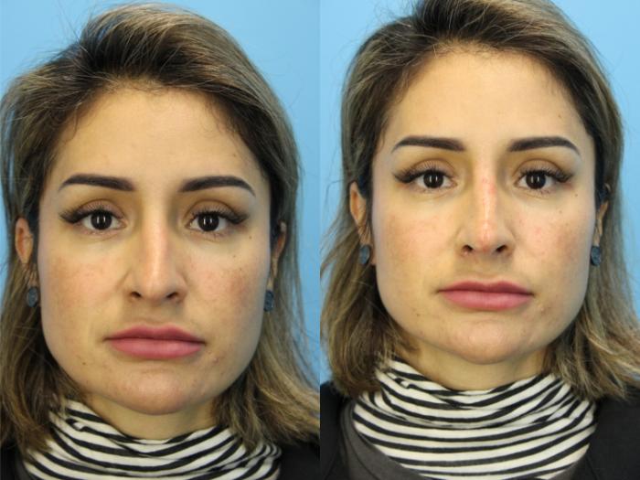 Before & After Dermal Fillers Case 576 Front View in West Des Moines & Ames, IA