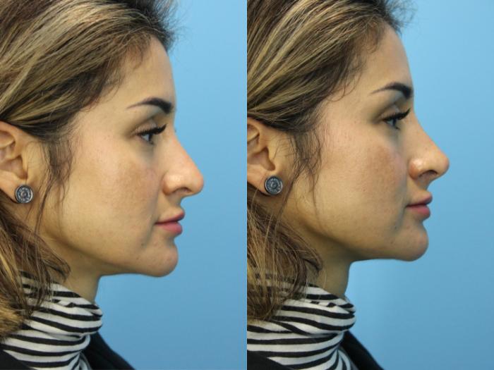 Before & After Dermal Fillers Case 576 Right Side View in West Des Moines & Ames, IA