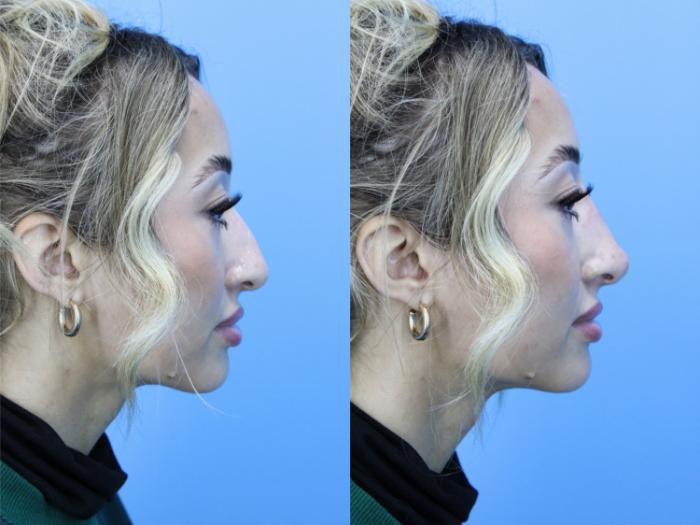 Before & After Dermal Fillers Case 609 Left Side View in West Des Moines & Ames, IA