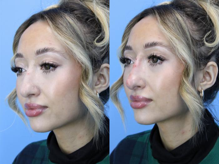 Before & After Dermal Fillers Case 609 Right Oblique View in West Des Moines & Ames, IA