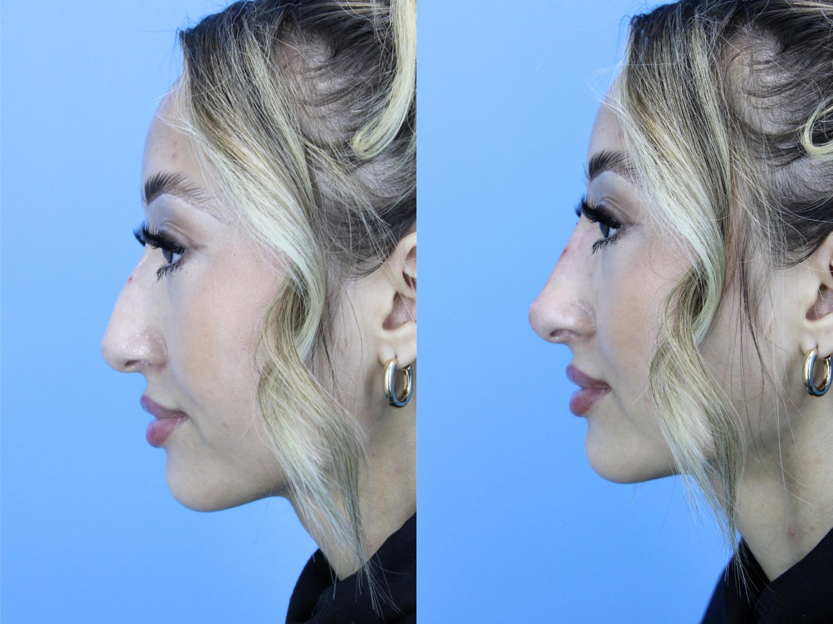 Before & After Dermal Fillers Case 609 Right Side View in West Des Moines & Ames, IA