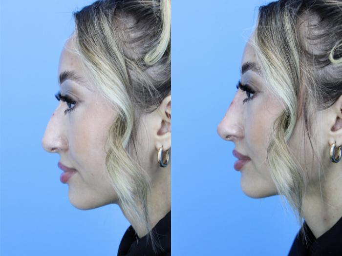 Before & After Dermal Fillers Case 609 Right Side View in West Des Moines & Ames, IA