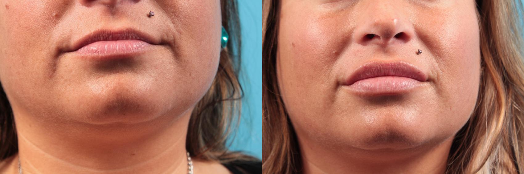 Before & After Dermal Fillers Case 65 View #1 View in West Des Moines, IA