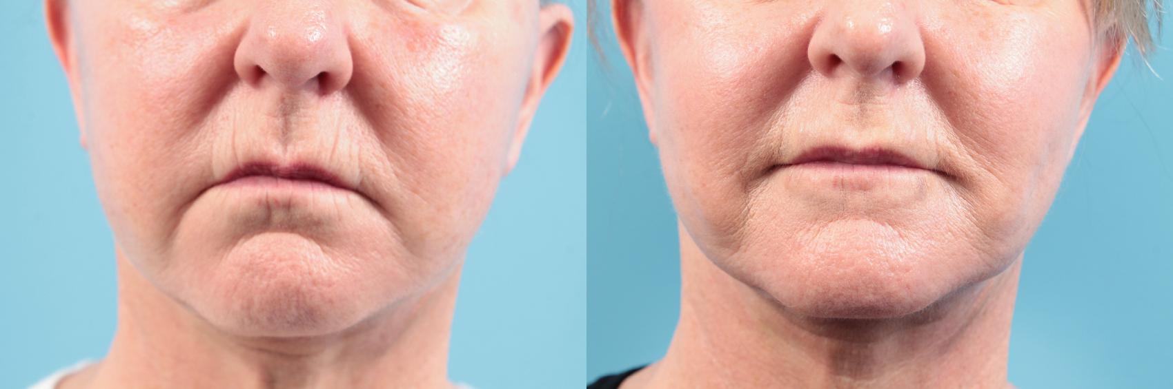 Before & After Dermal Fillers Case 97 View #1 View in West Des Moines, IA