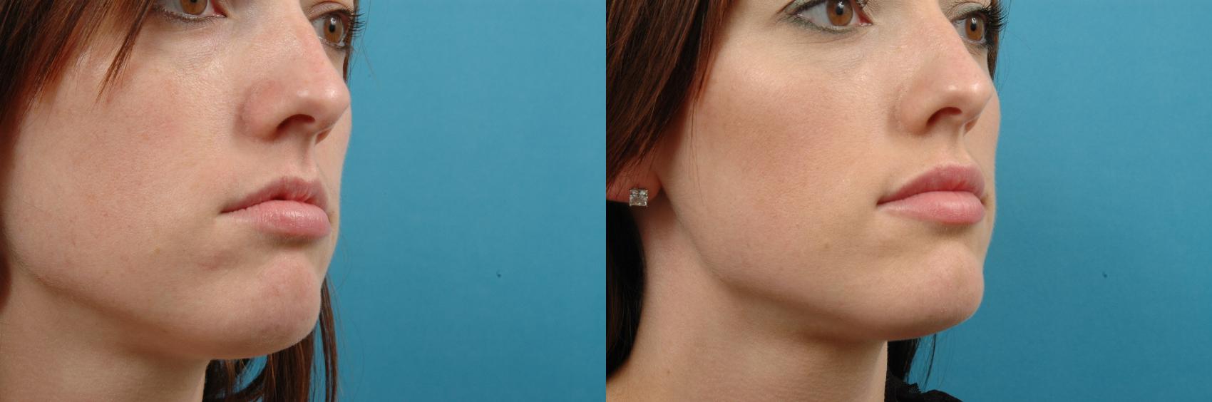 Before & After Dermal Fillers Case 98 View #1 View in West Des Moines, IA