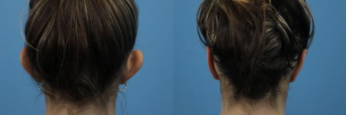 Before & After Ear Surgery Case 306 Back View in West Des Moines & Ames, IA