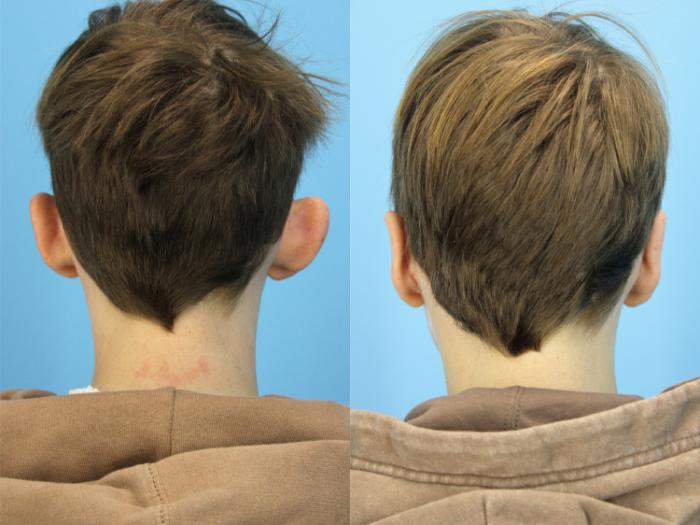 Before & After Ear Surgery Case 579 Back View in West Des Moines & Ames, IA