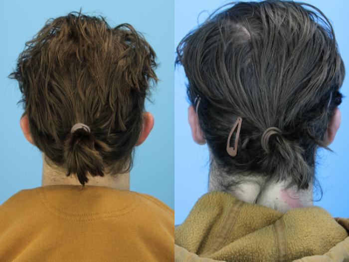 Before & After Ear Surgery Case 628 Back View in West Des Moines & Ames, IA