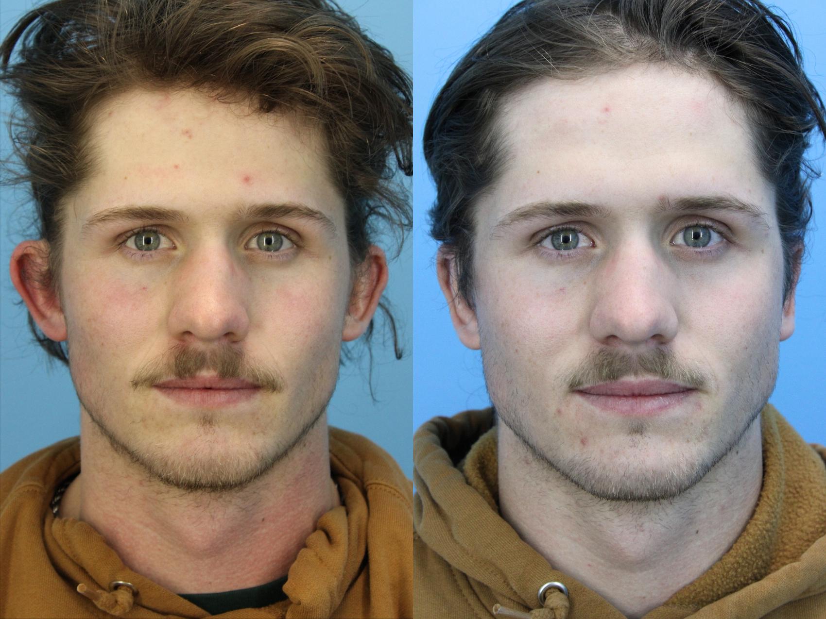 Before & After Ear Surgery Case 628 Front View in West Des Moines & Ames, IA