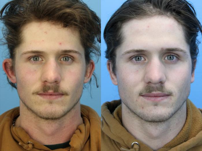 Before & After Ear Surgery Case 628 Front View in West Des Moines & Ames, IA