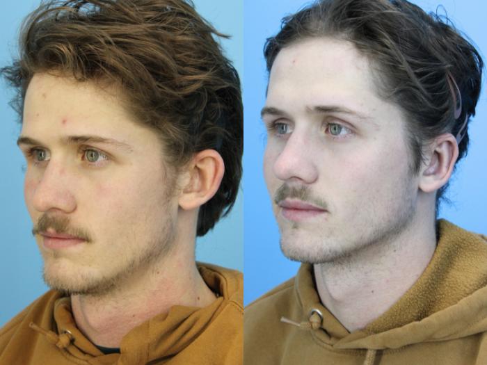 Before & After Ear Surgery Case 628 Left Oblique View in West Des Moines & Ames, IA