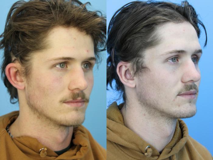 Before & After Ear Surgery Case 628 Left Side View in West Des Moines & Ames, IA