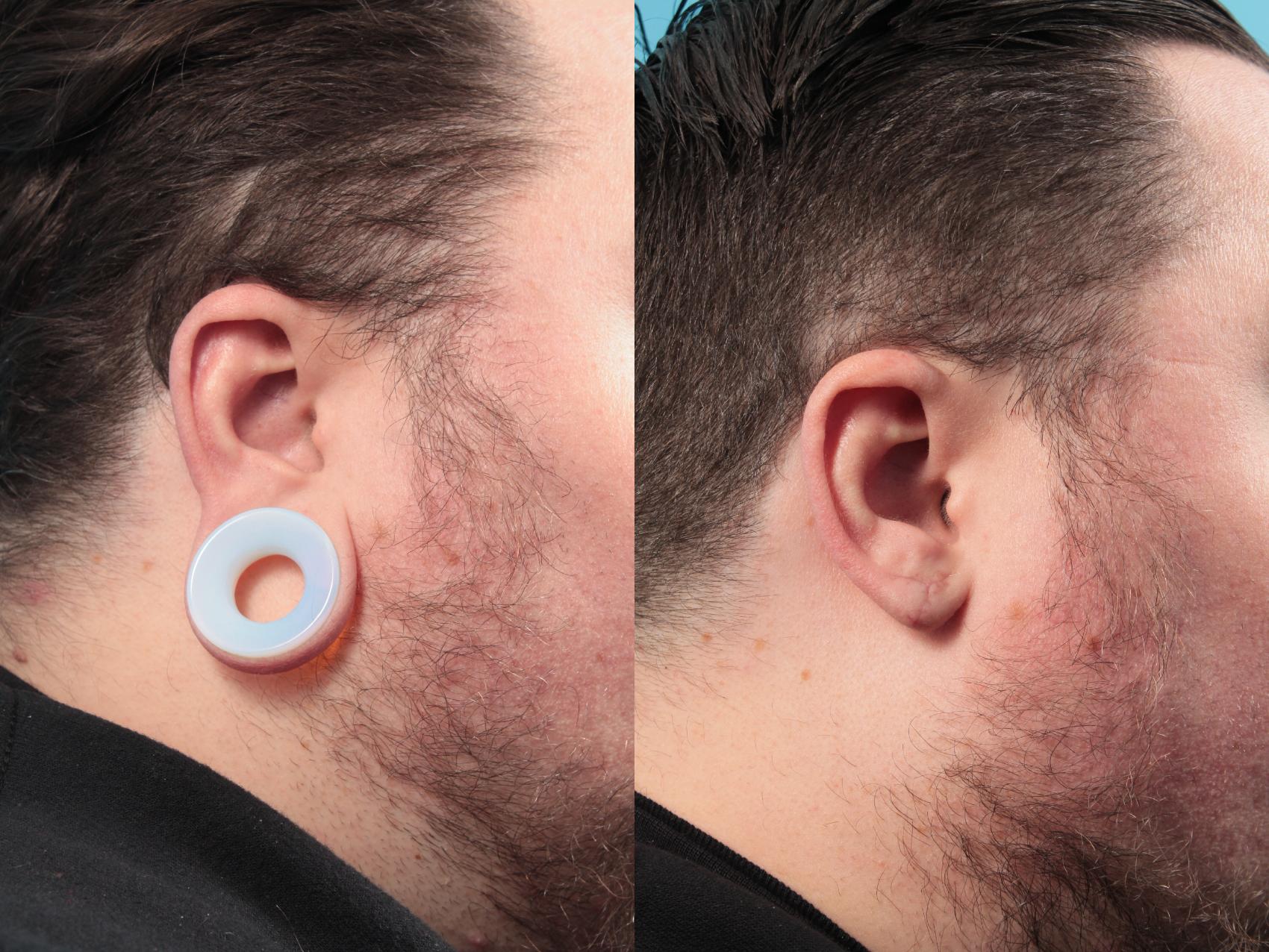 Before & After Earlobe Repair (Gauged) Case 45 View #1 View in West Des Moines & Ames, IA