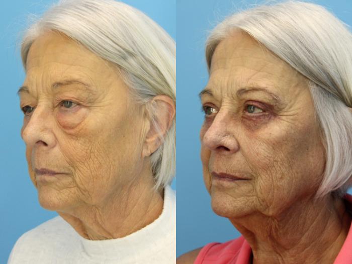 Before & After Eyelid Surgery (Lower, Under Eyes) Case 532 Left Oblique View in West Des Moines & Ames, IA