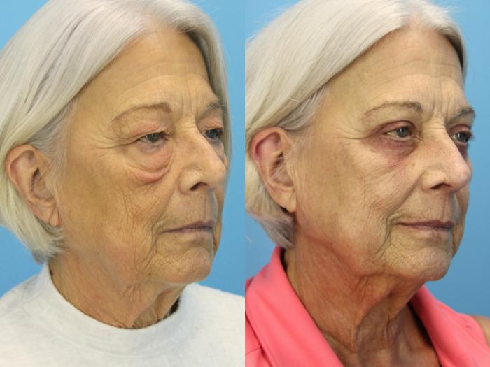 Before & After Eyelid Surgery (Lower, Under Eyes) Case 532 Right Oblique View in West Des Moines & Ames, IA