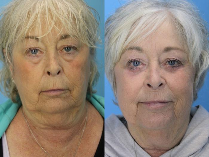 Before & After Eyelid Surgery (Lower, Under Eyes) Case 640 Profile View in West Des Moines & Ames, IA