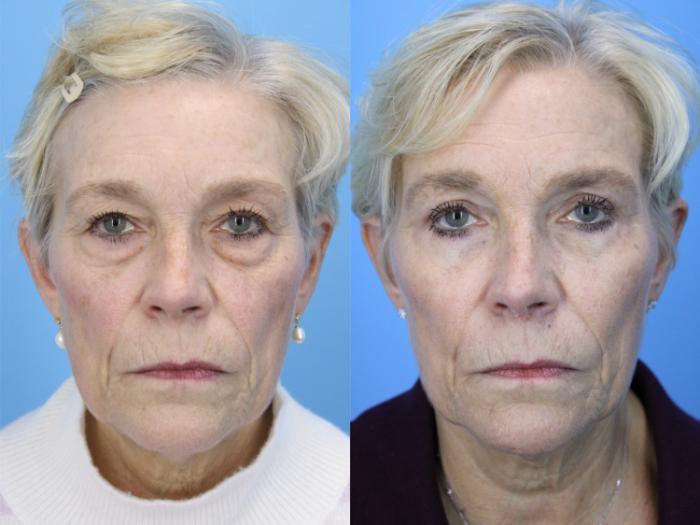 Before & After Eyelid Surgery (Lower, Under Eyes) Case 659 Front View in West Des Moines & Ames, IA