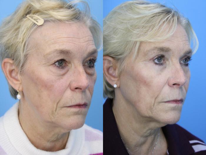 Before & After Eyelid Surgery (Lower, Under Eyes) Case 659 Left Oblique View in West Des Moines & Ames, IA