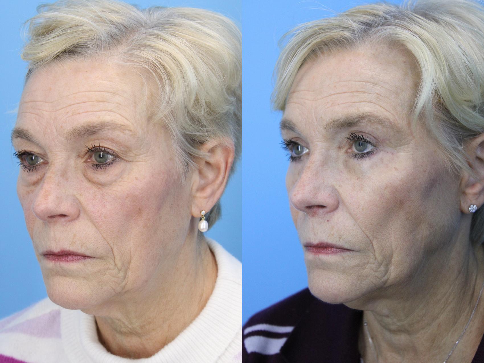 Before & After Eyelid Surgery (Lower, Under Eyes) Case 659 Left Side View in West Des Moines & Ames, IA
