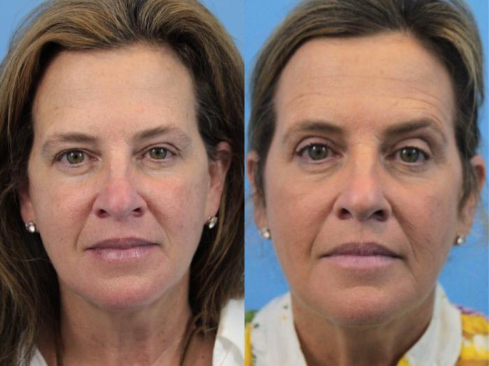 Before & After Eyelid Surgery (Upper Eyelid Lift) Case 217 Front View in West Des Moines & Ames, IA