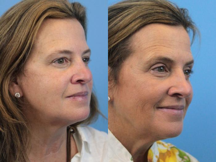Before & After Eyelid Surgery (Upper Eyelid Lift) Case 217 Right Oblique View in West Des Moines & Ames, IA
