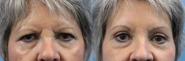 Before & After Eyelid Surgery (Upper Eyelid Lift) Case 219 Eyes View in West Des Moines & Ames, IA
