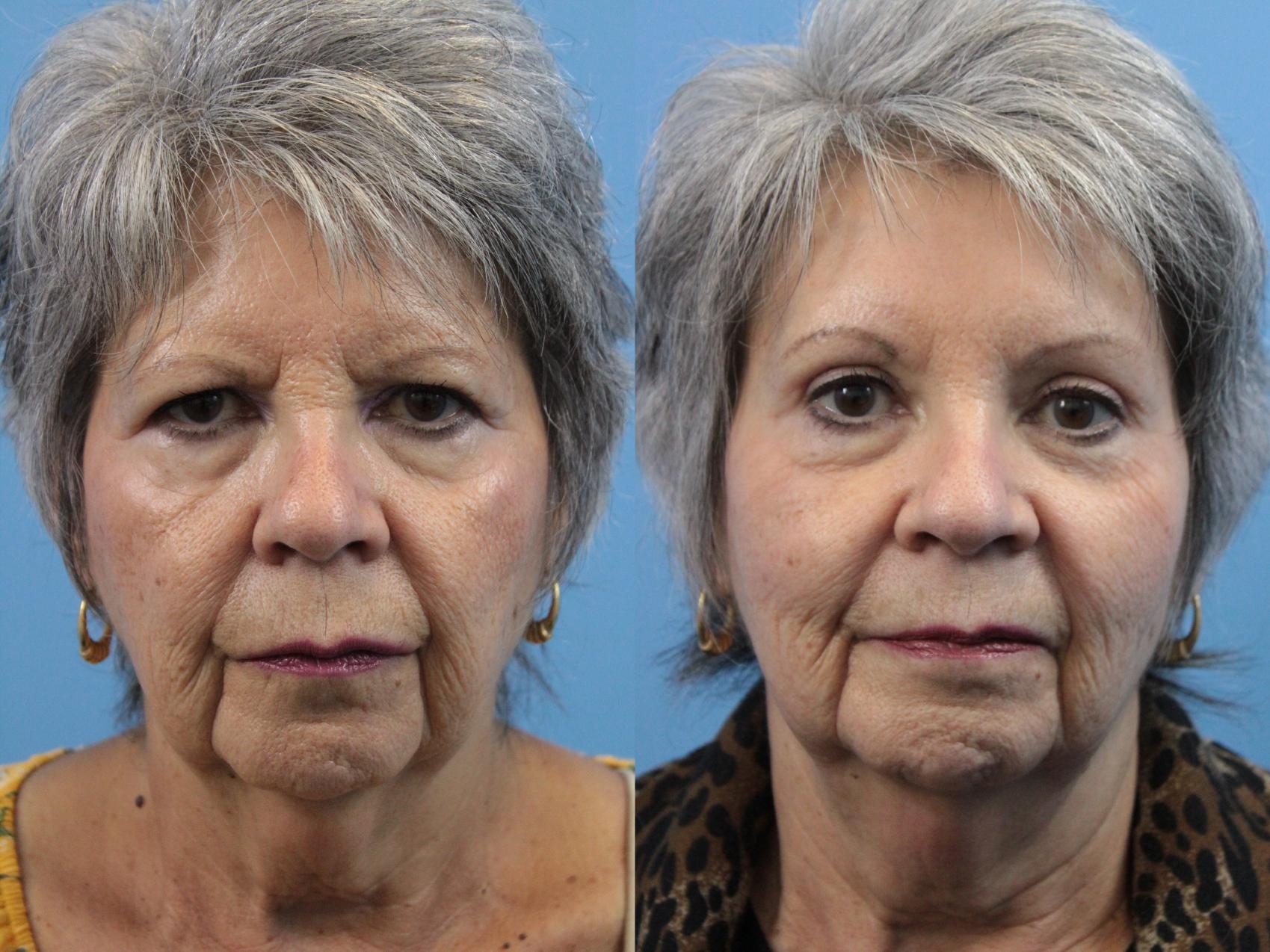 Before & After Eyelid Surgery (Upper Eyelid Lift) Case 219 Front View in West Des Moines & Ames, IA